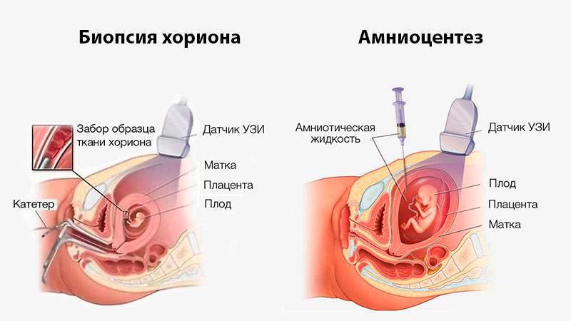 Амніоцентез та біопсія