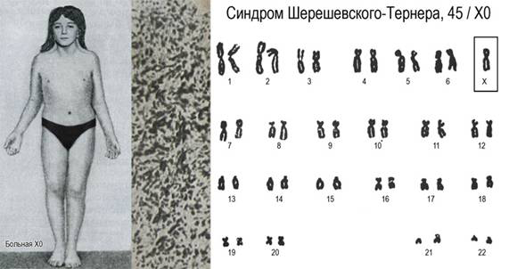 Синдром Шерешевського-Тернера - Моносомія X