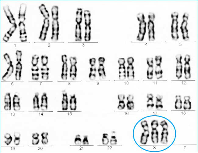 Трисомія по X-хромосомі (XXX)