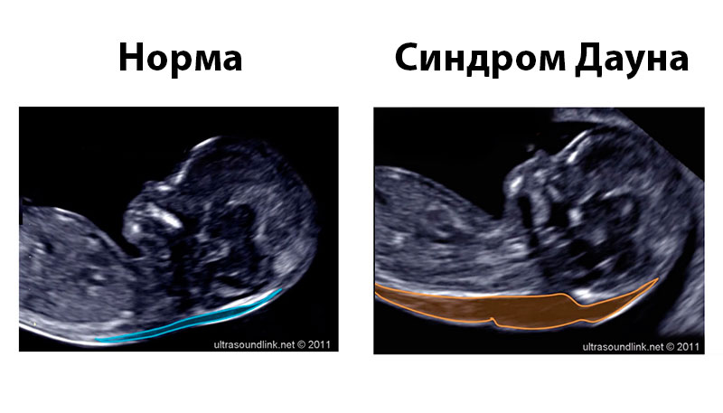 Гипоплазия 12 недель