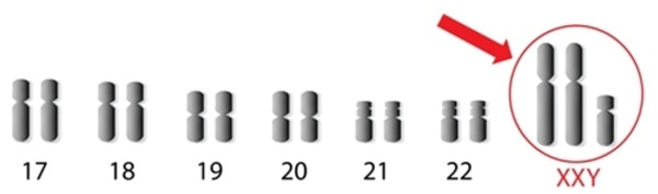 Синдром Клайнфельтера (XXY)